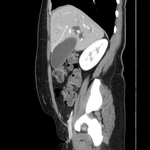 File:Ampullary tumor (Radiopaedia 22787-22816 D 17).jpg