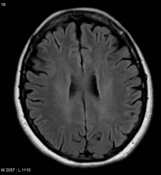 File:Amyotrophic lateral sclerosis (Radiopaedia 5373-7134 Axial FLAIR 16).jpg