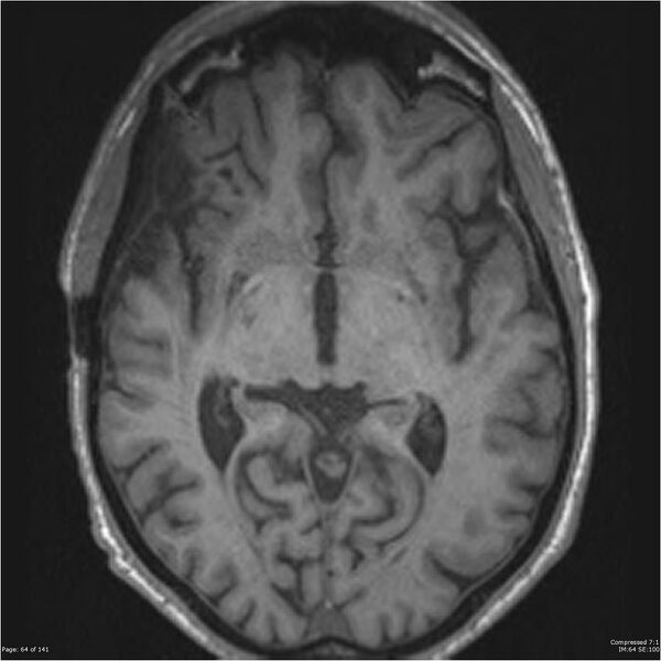 File:Anaplastic meningioma with recurrence (Radiopaedia 34452-35788 Axial T1 62).jpg