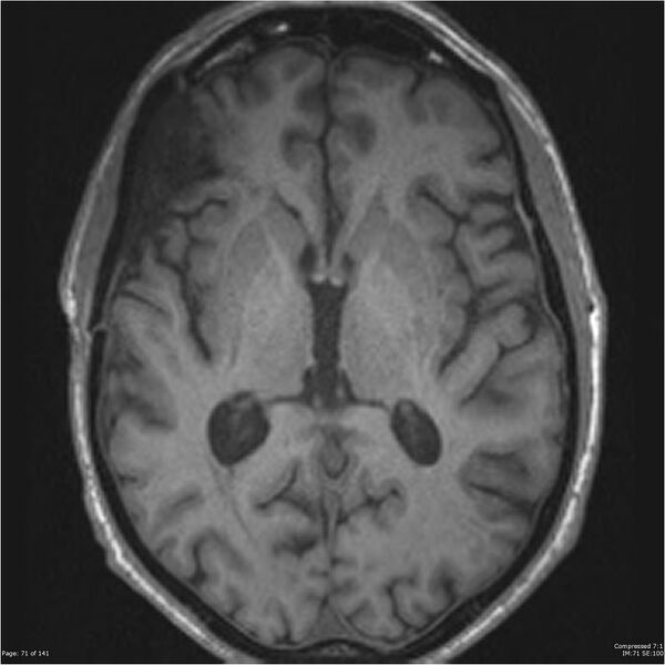 File:Anaplastic meningioma with recurrence (Radiopaedia 34452-35788 Axial T1 69).jpg