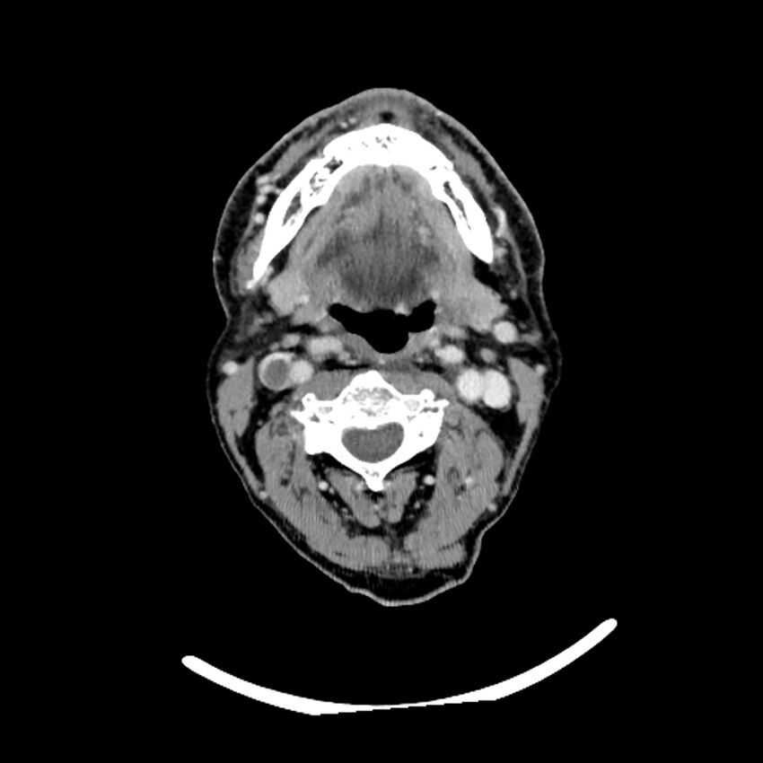 Anaplastic thyroid carcinoma (Radiopaedia 79087-92034 B 83).jpg
