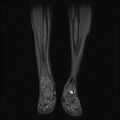 Aneurysmal bone cyst - tibia (Radiopaedia 22343-22367 Coronal STIR 6).jpg