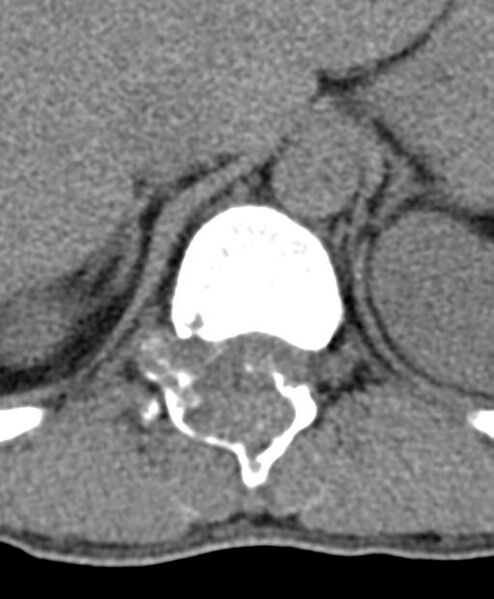 File:Aneurysmal bone cyst T11 (Radiopaedia 29294-29721 Axial non-contrast 45).jpg