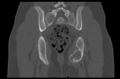 Aneurysmal bone cyst of ischium (Radiopaedia 25957-26094 Coronal bone window 30).png