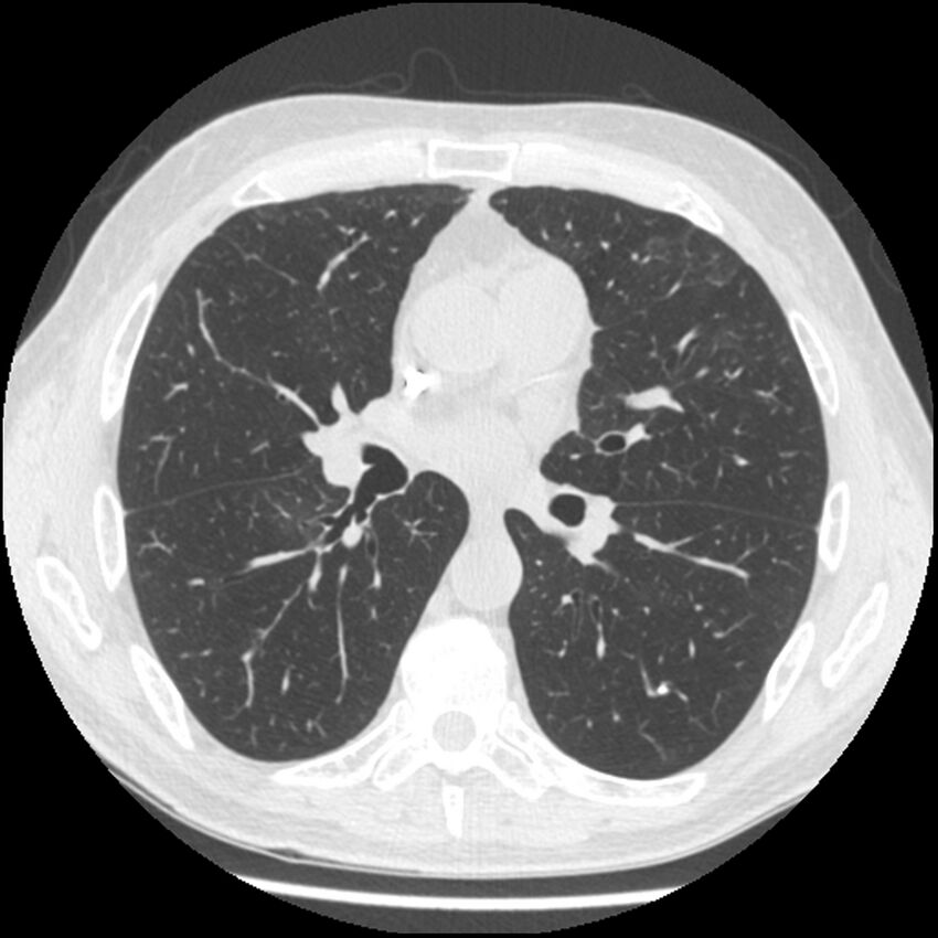 Angioinvasive aspergillosis (Radiopaedia 43957-47466 Axial lung window 35).jpg