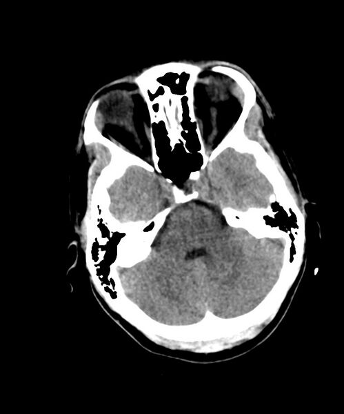 File:Angiomatous meningioma (Radiopaedia 79459-92578 Axial non-contrast 9).jpg