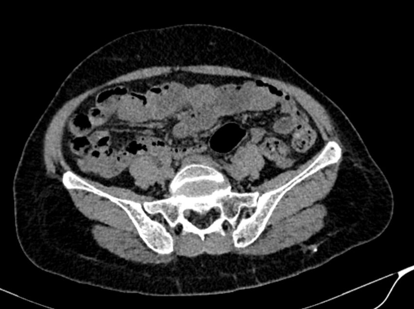 Angiomyolipoma (Radiopaedia 83682-98824 Axial non-contrast 44).jpg
