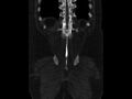 Ankylosing spondylitis (Radiopaedia 44609-48357 Coronal bone window 92).jpg