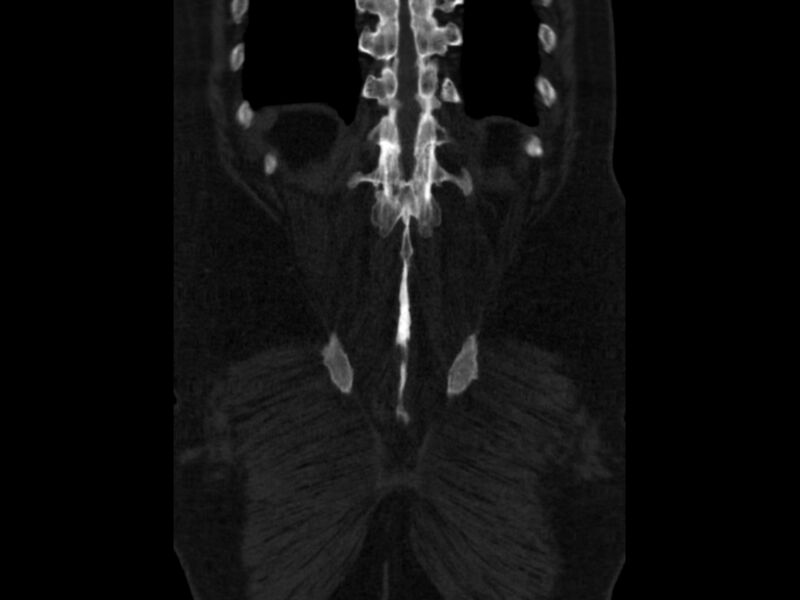 File:Ankylosing spondylitis (Radiopaedia 44609-48357 Coronal bone window 92).jpg