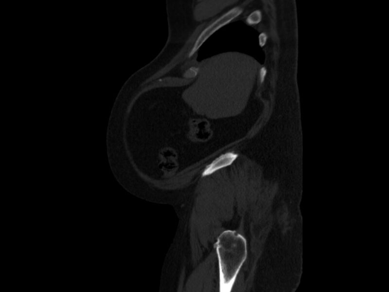 File:Ankylosing spondylitis (Radiopaedia 44609-48357 Sagittal bone window 104).jpg