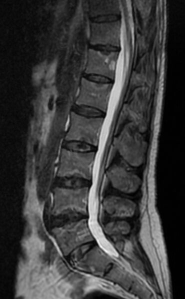 File:Ankylosing spondylitis - Andersson lesion (Radiopaedia 81878-95838 Sagittal T2 7).jpg