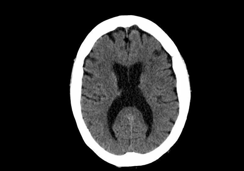 File:Anomalous intracranial venous drainage (Radiopaedia 28161-28418 Axial non-contrast 26).jpg
