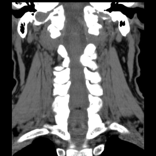 File:Anterior cervical postdiscectomy arthrodesis (Radiopaedia 32678-33646 Coronal non-contrast 20).jpg