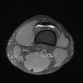 Anterior cruciate ligament full thickness tear (Radiopaedia 66268-75467 Axial PD fat sat 2).jpg