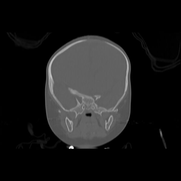 File:Anterior plagiocephaly (Radiopaedia 71836-82273 Coronal bone window 4).jpg
