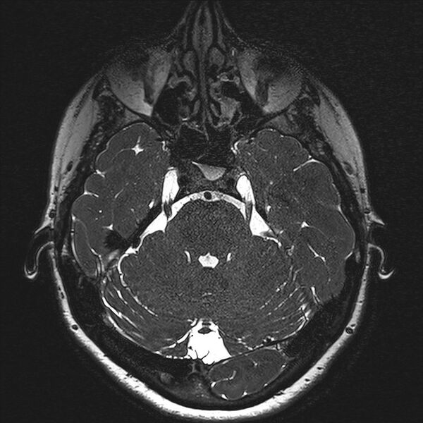File:Anterior temporal encephalocele (Radiopaedia 82624-96808 Axial T2 high res 40).jpg