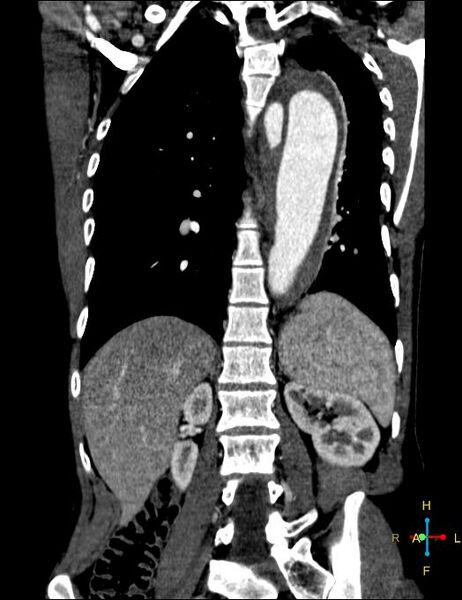 File:Aortic aneurysm and penetrating ulcer (Radiopaedia 23590-23704 B 18).jpg