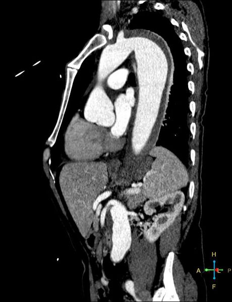 File:Aortic aneurysm and penetrating ulcer (Radiopaedia 23590-23704 C 9).jpg