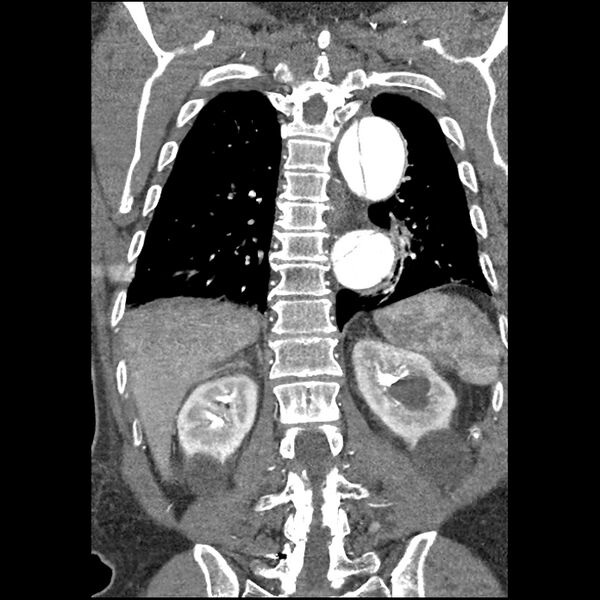 File:Aortic dissection - DeBakey Type I-Stanford A (Radiopaedia 79863-93115 B 29).jpg