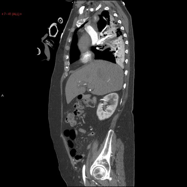 File:Aortic intramural hematoma (Radiopaedia 27746-28001 C 10).jpg