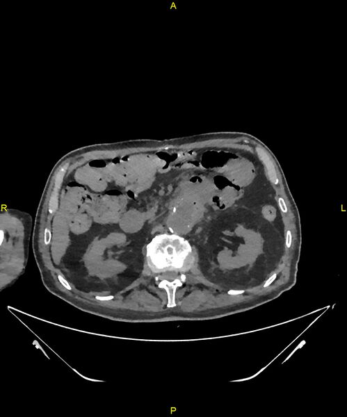 File:Aortoenteric fistula (Radiopaedia 84308-99603 Axial non-contrast 124).jpg