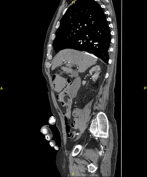 File:Aortoenteric fistula (Radiopaedia 84308-99603 C 117).jpg