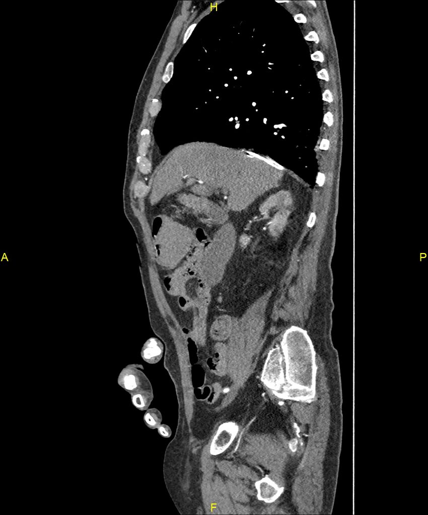Aortoenteric fistula (Radiopaedia 84308-99603 C 117).jpg