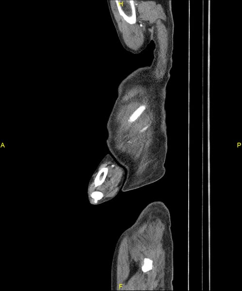 File:Aortoenteric fistula (Radiopaedia 84308-99603 C 12).jpg