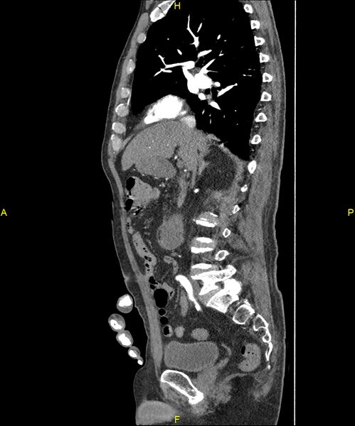 File:Aortoenteric fistula (Radiopaedia 84308-99603 C 143).jpg
