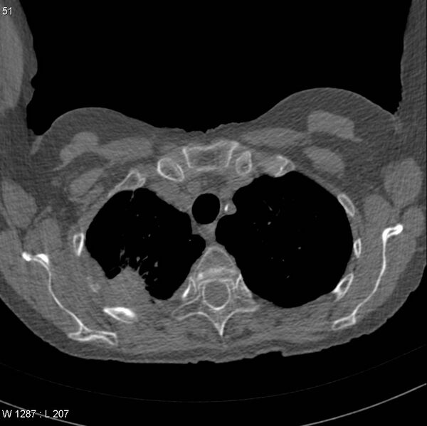 File:Apical non-small-cell lung cancer (Radiopaedia 8570-9405 Axial non-contrast 6).jpg