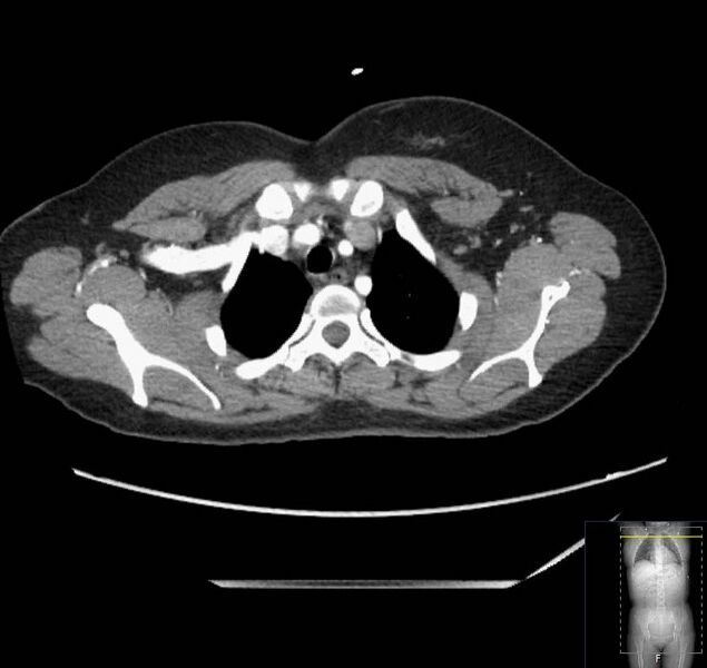 File:Appendicitis (CT angiogram) (Radiopaedia 154713-127660 Axial 230).jpg