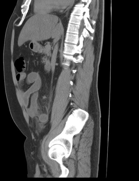 File:Appendicitis and giant appendicolith (Radiopaedia 80251-93588 C 15).jpg