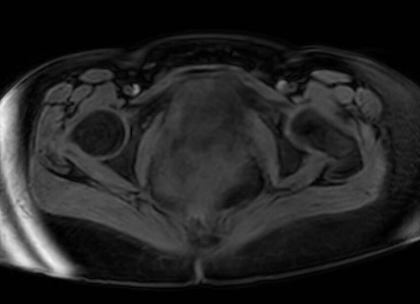 Appendicitis in gravida (MRI) (Radiopaedia 89433-106395 Axial DIXON 145).jpg