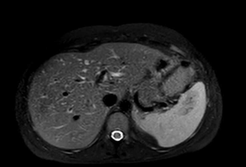 File:Appendicitis in gravida (MRI) (Radiopaedia 89433-106395 Axial T2 SPAIR 15).jpg