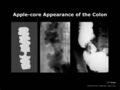 Apple-core appearance of the colon (Radiopaedia 21968-21959 A 1).jpg