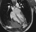 Arrhythmogenic right ventricular cardiomyopathy (Radiopaedia 39806-42237 D 85).jpg