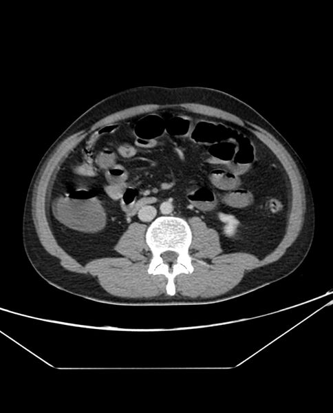 File:Arterial occlusive mesenteric ischemia (Radiopaedia 84641-100054 A 61).jpg