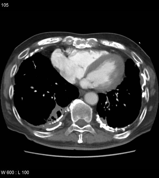 File:Asbestos related lung and pleural disease (Radiopaedia 14377-14301 D 41).jpg