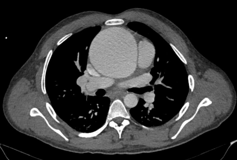 File:Ascending aortic aneurysm (Radiopaedia 86279-102297 C 25).jpg
