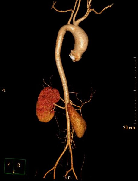 File:Ascending aortic pseudoaneurysm (Radiopaedia 28638-28910 D 12).jpg