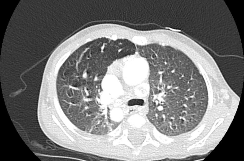 File:Asplenia syndrome (Radiopaedia 73083-83792 Axial lung window 23).jpg