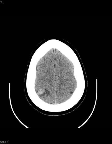 File:Astroblastoma (Radiopaedia 39792-42216 Axial non-contrast 41).jpg