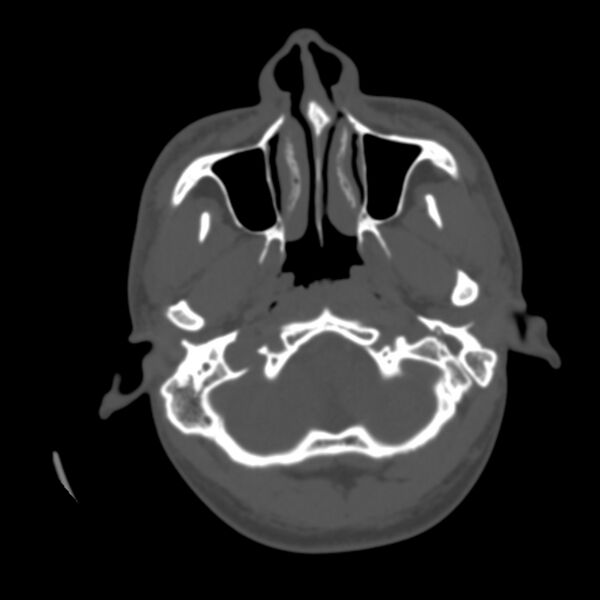 File:Asymptomatic occipital spur (Radiopaedia 87753-104201 Axial bone window 11).jpg