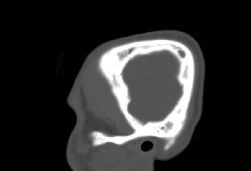 Asymptomatic occipital spur (Radiopaedia 87753-104201 Sagittal bone window 15).jpg