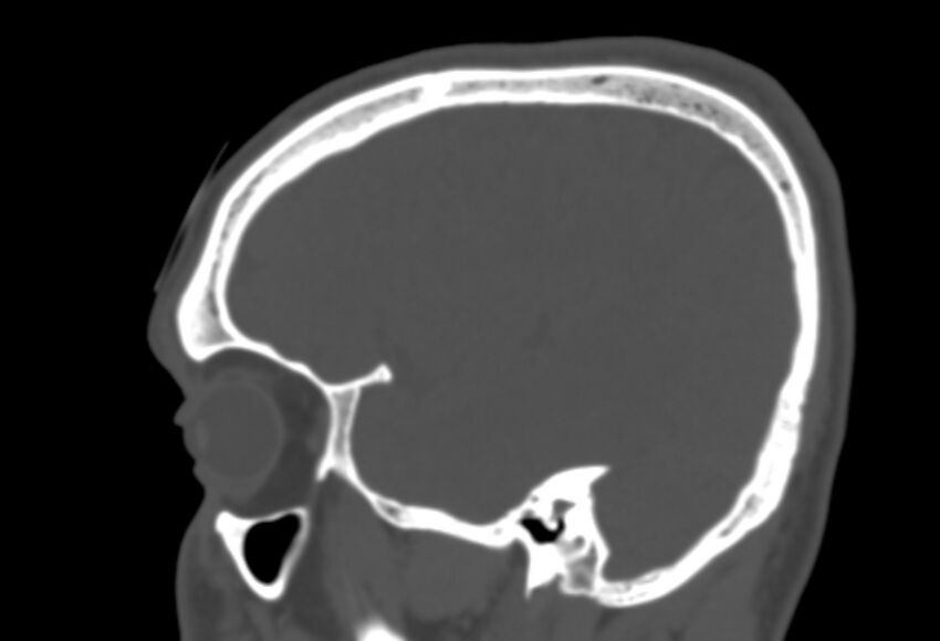 Asymptomatic occipital spur (Radiopaedia 87753-104201 Sagittal bone window 68).jpg