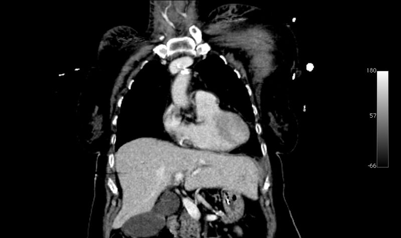 File:Atypical dissection of the thoracic aorta (Radiopaedia 10975-78320 B 2).jpg