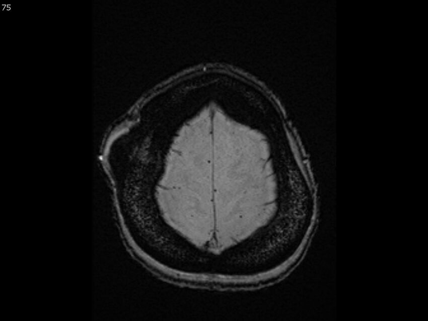 Atypical meningioma - intraosseous (Radiopaedia 64915-74572 Axial SWI 75).jpg