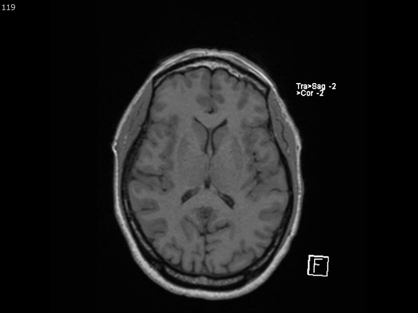 Atypical meningioma - intraosseous (Radiopaedia 64915-74572 Axial T1 119).jpg