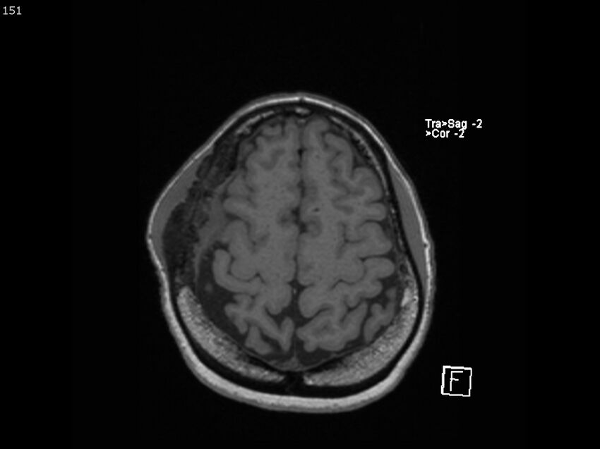 Atypical meningioma - intraosseous (Radiopaedia 64915-74572 Axial T1 151).jpg