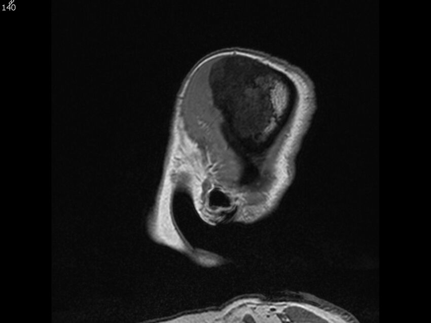 Atypical meningioma - intraosseous (Radiopaedia 64915-74572 Sagittal T1 140).jpg